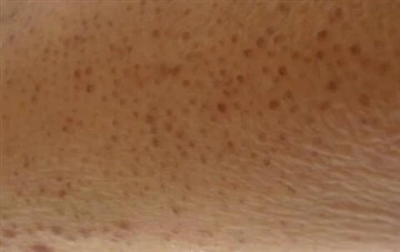 2-hidroksiasetik Asit Keratosis Pilaris'i Tedavi Edebilir mi?